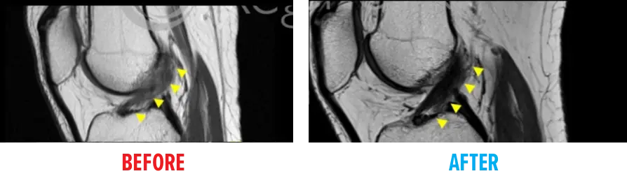 Knee MRI ACL Tear Before & After